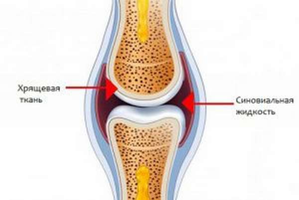 Синдром медиопателлярной складки колена